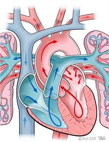 Persistent Pulmonary Hypertension In The Neonate Pphn - 