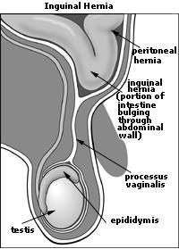 Inguinal Hernia Surgery Symptoms For Children