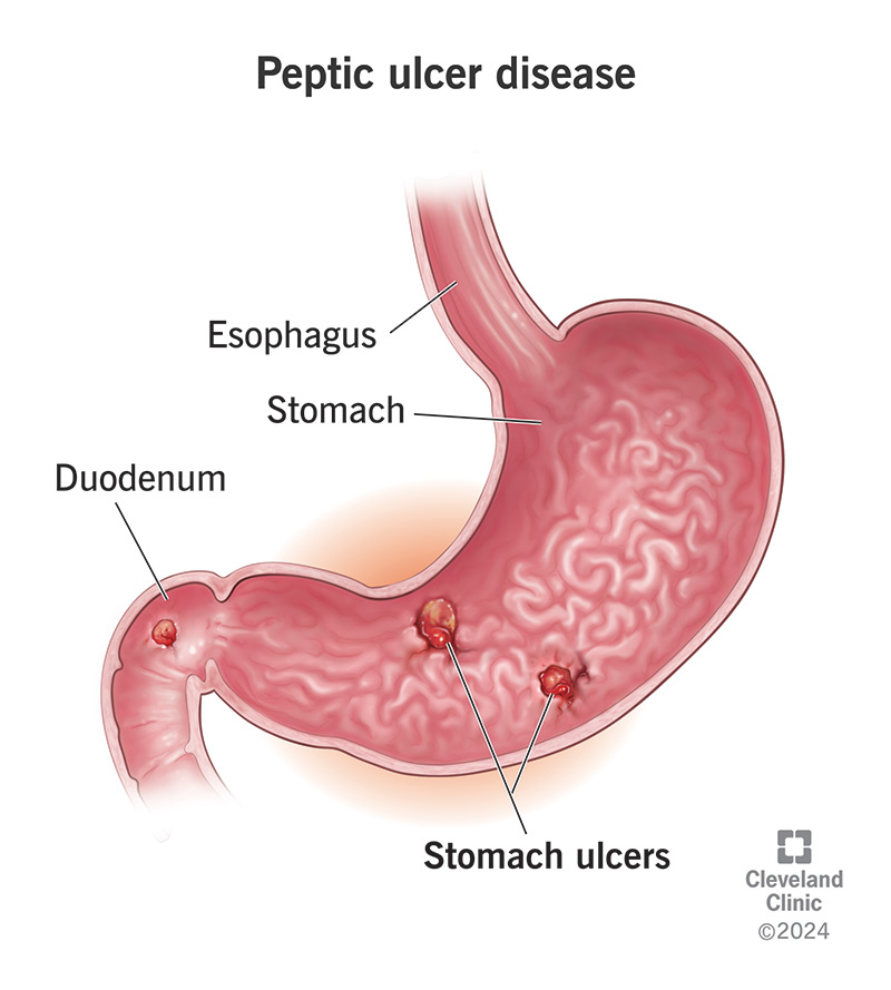 Inside view of stomach and small intestine with peptic ulcers.