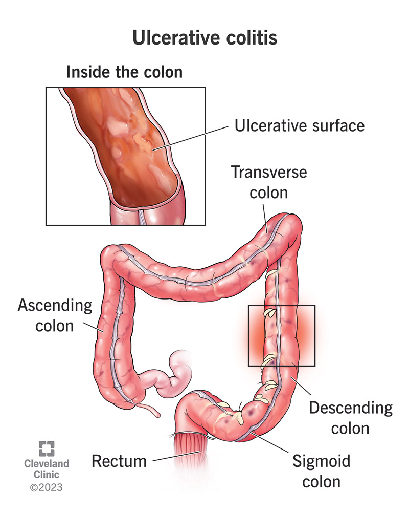 Inflammation and ulcers in the descending colon