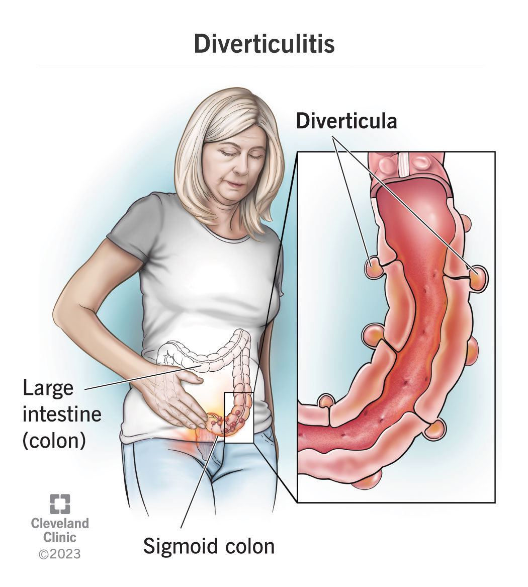 Diverticula, tiny pockets in the lining of your colon, can become infected and inflamed (diverticulitis).