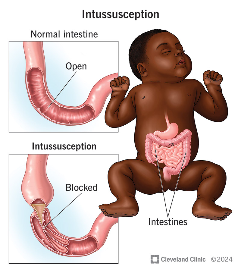 An open, healthy intestine compared to a blocked intestine with intussusception.