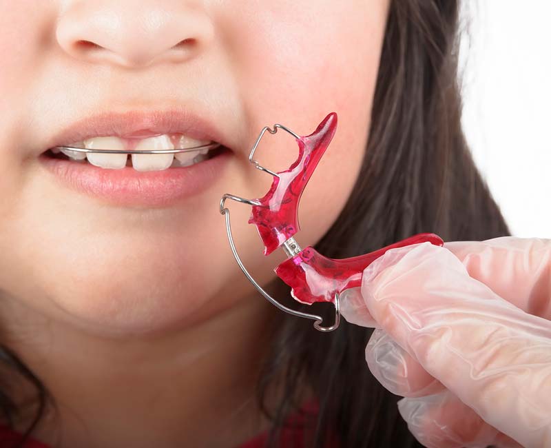 A child wearing a retainer and a gloved hand shows what a teeth retainer looks like outside the mouth.