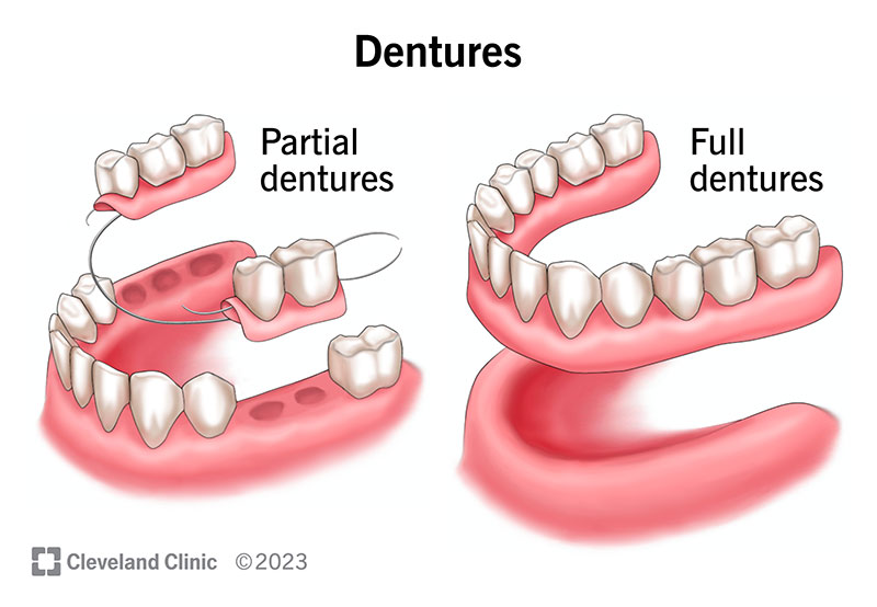 Partial dentures vs. full dentures.