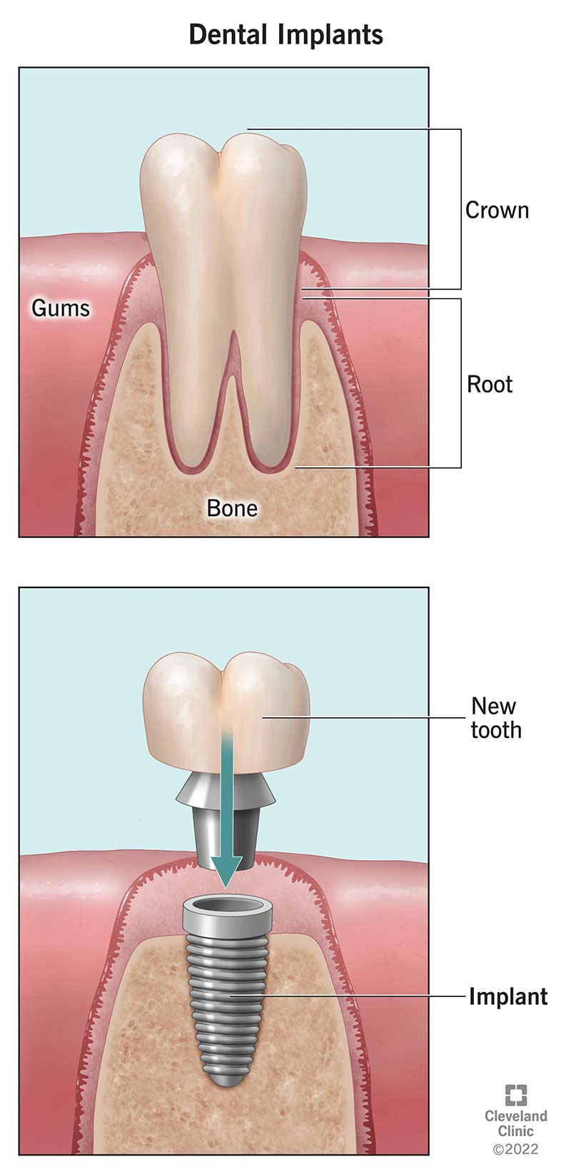 Natural tooth vs. dental implant in jawbone.