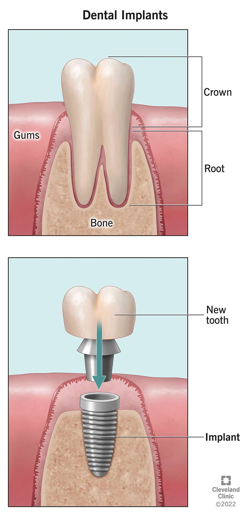 Dental implants Kent