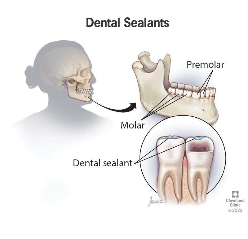 Dental sealants placed on chewing surfaces of molar teeth.