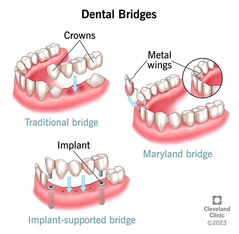 Four types of dental bridges, including traditional, implant-supported and Maryland.
