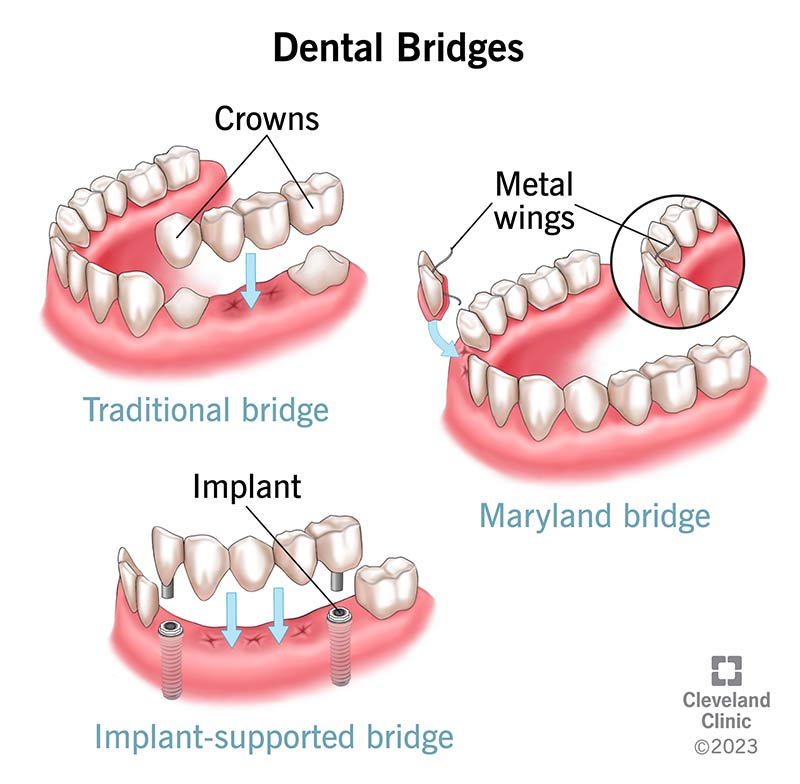 How Strong Are Dental Bridges? | Dentist Norcross & Alpharetta, GA