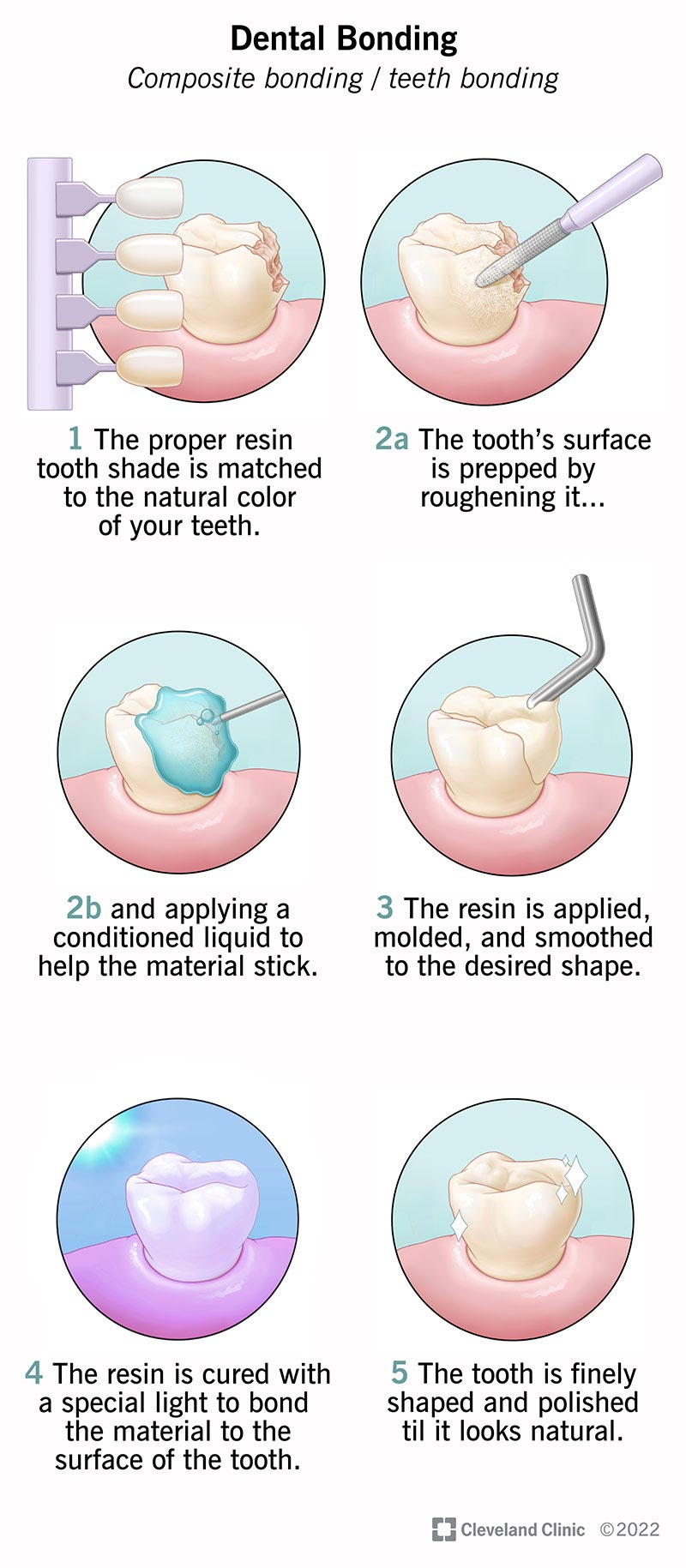 step-by-step explanation of dental bonding procedure