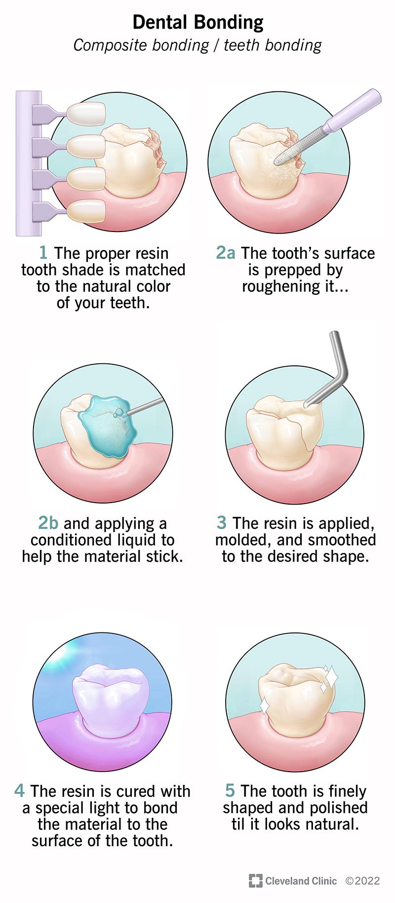 Dental Bonding: What is Teeth Bonding & What to Expect