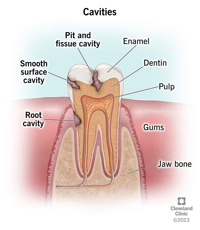 Cross section of tooth showing types of cavities: pit and fissure, smooth surface and root.