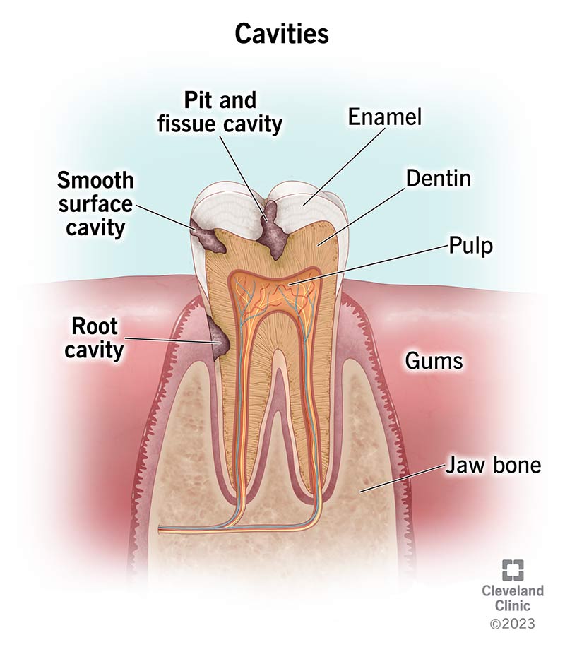 early stage cavity