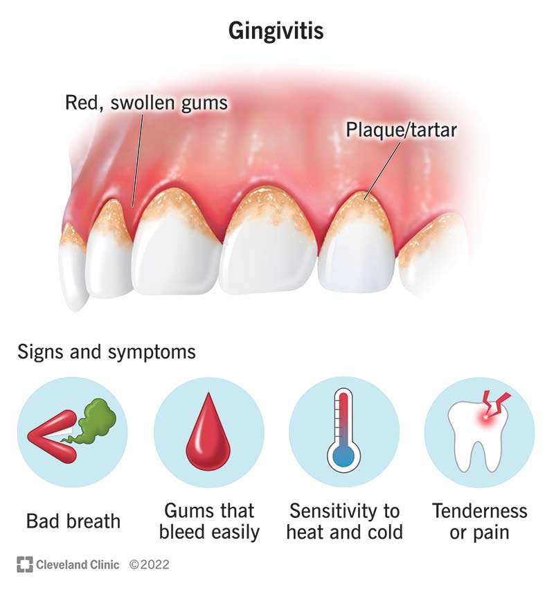 Gingivitis signs and symptoms.