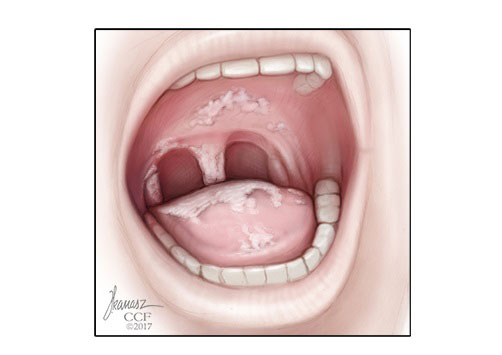 Thrush (fungal yeast infection) on person's tongue, throat and roof of mouth.