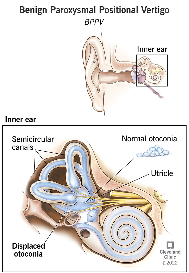 How otoconia from the utricle get trapped in the semicircular canals of the inner ear, causing BPPV.