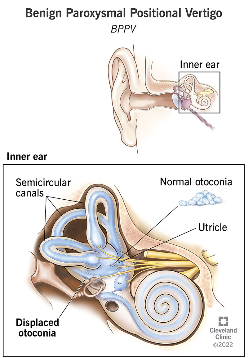 Benign Paroxysmal Positional Vertigo BPPV Treatment Symptoms Causes