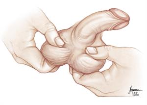 A hand grips a scrotum, which contains a partially visible testicle.