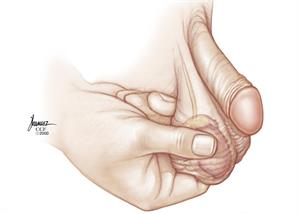 The thumb, index finger, and middle finger of the left hand gently squeeze the left testicle while the thumb, index finger, and middle finger of the right hand gently squeeze the right testicle.