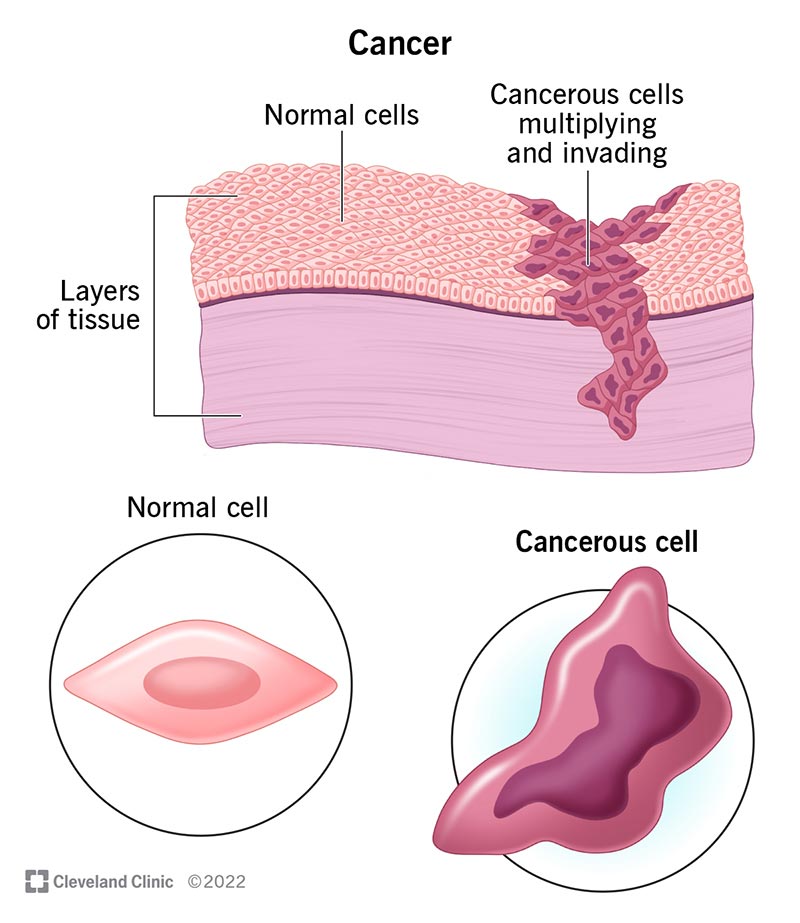 Cancerous cells multiplying and invading tissue. Close-up of normal cell (below left) and cancerous cell (below right).