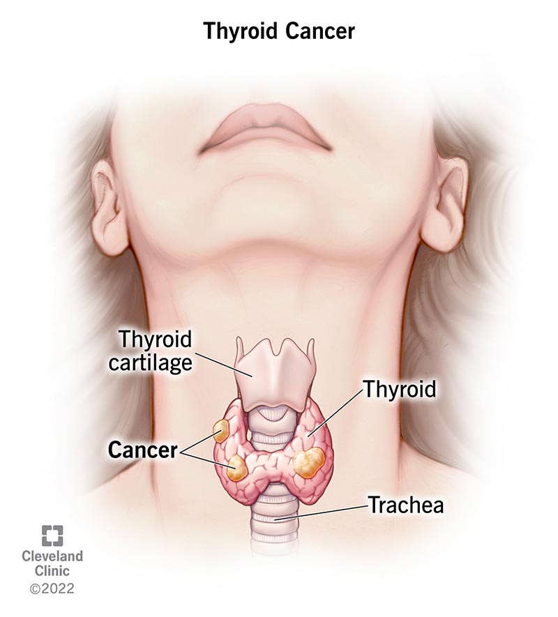 Cancer lesions on thyroid gland.