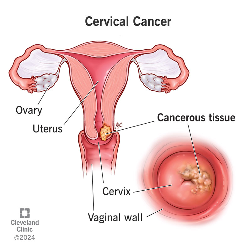 Medical illustration of cervical cancer anatomy with cervix and cancerous tissue inset