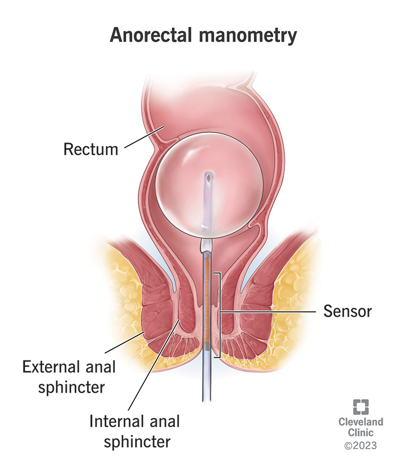 An anorectal manometer, a tube with an inflatable balloon at the end, inside a rectum.