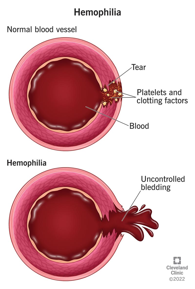 Medical illustration comparing normal clotting with hemophilia and uncontrolled bleeding