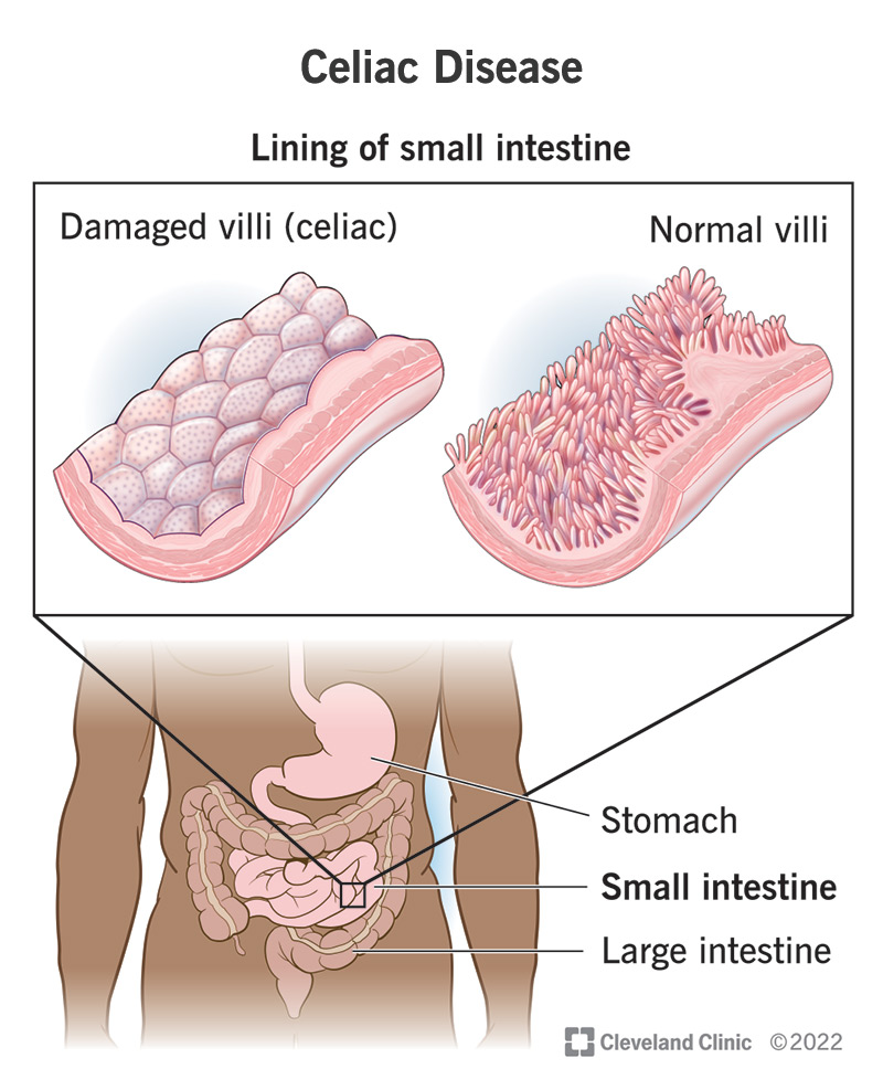Celiac disease does visible damage to your small intestine.