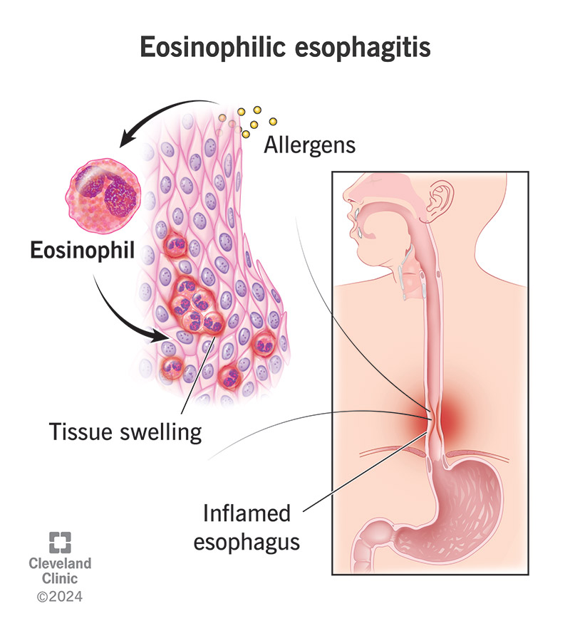Eosinophilic esophagitis is inflammation of the esophagus (inset) that happens when eosinophils react to allergens (top left)