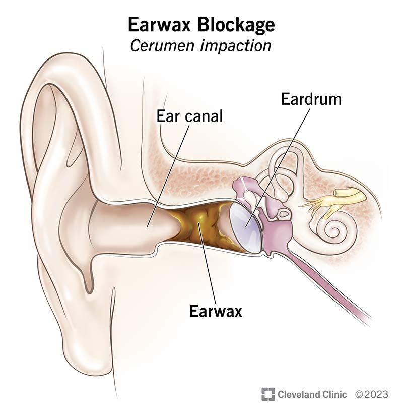 Cross section of ear canal with earwax blockage.
