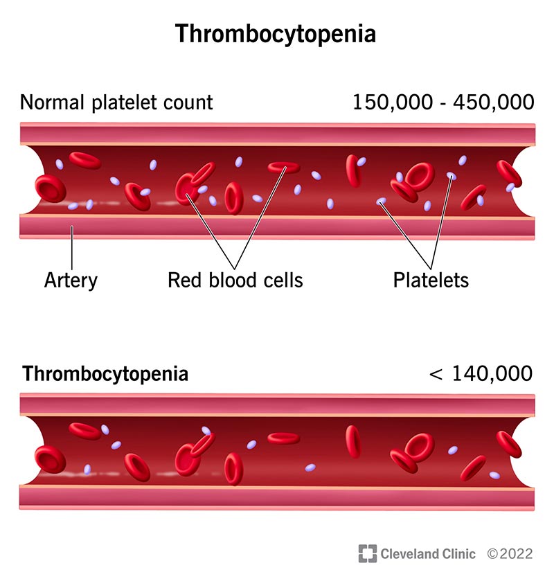 Thrombocytopenia: Symptoms, Stages & Treatment