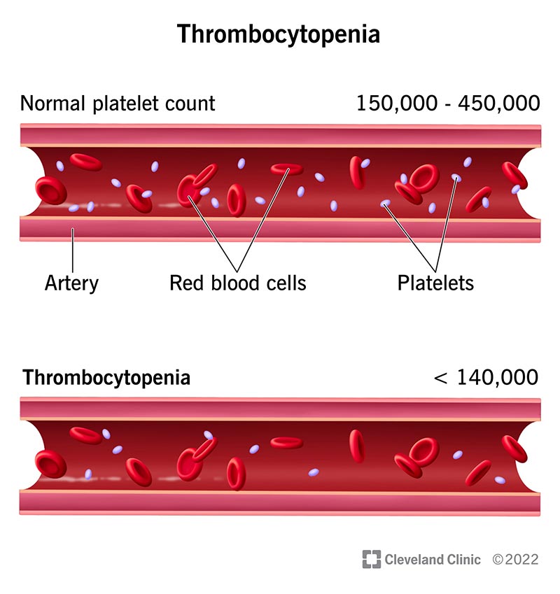 thrombocytopenia-symptoms-stages-treatment