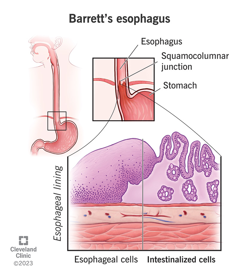 Illustration of the cells inside a normal esophagus and Barret's esophagus.