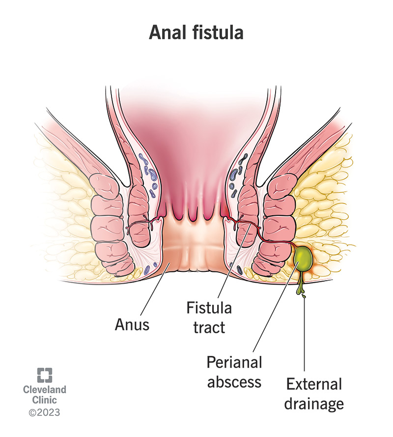 Anal fistula leading from the wall of the anal canal to the outside skin of the buttocks.