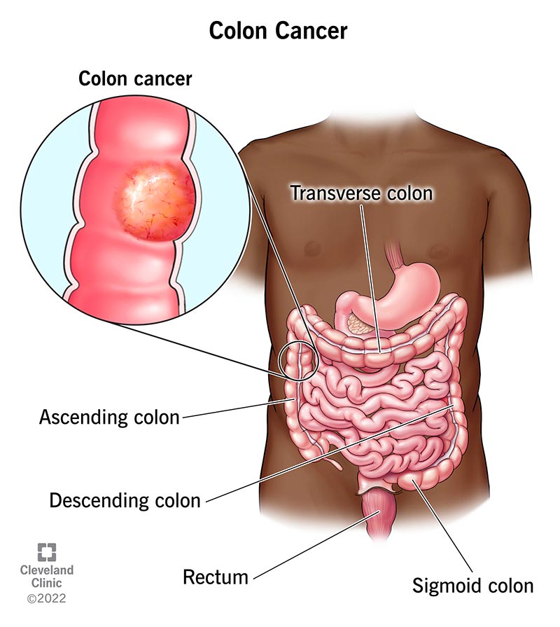 At right transverse colon (top center), descending colon (at right) sigmoid colon (lower right), rectum (bottom center), ascending colon at left. Inset at left: cancerous colon polyp.