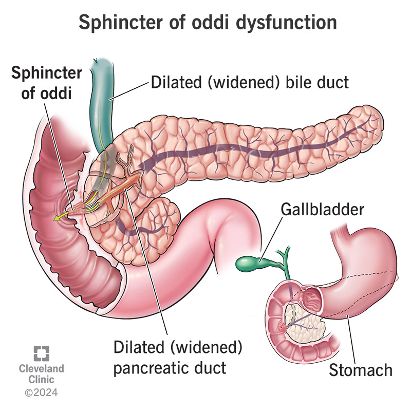 An opened Sphincter of Oddi allowing bile and pancreatic juices to flow into the small intestine