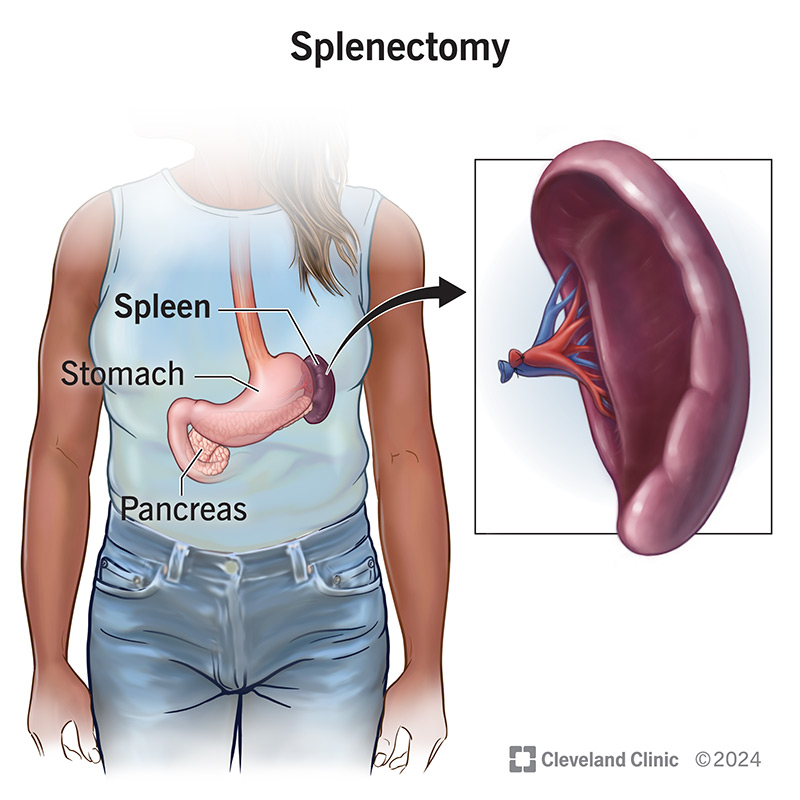 A fully intact spleen before and after a splenectomy to remove it