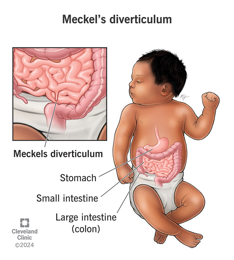 Inside view of a baby's intestines showing a small pocket in the small intestine.