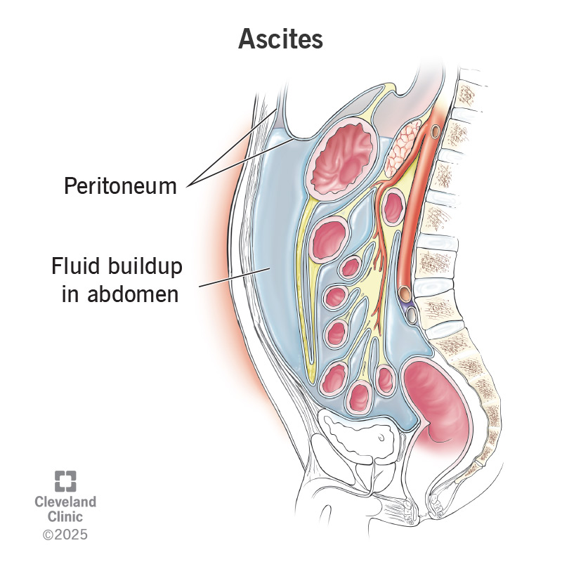 A swollen abdominal cavity with fluid buildup inside