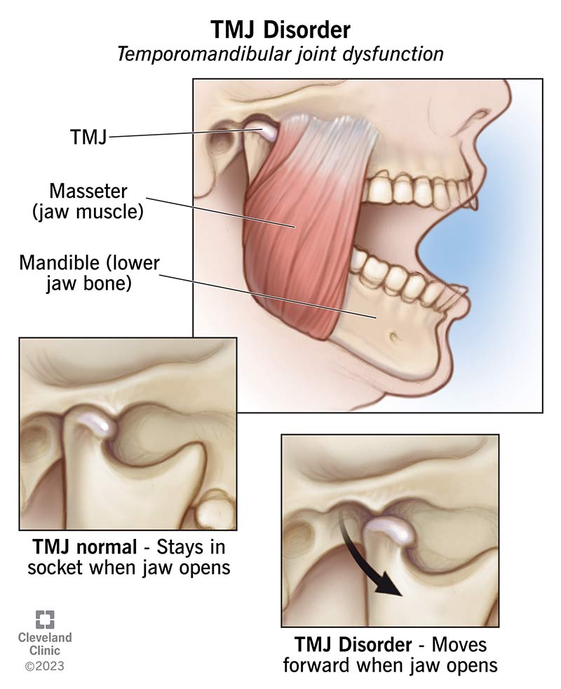 Normal TMJ vs. TMJ disorder, showing dislocation of jaw joint.