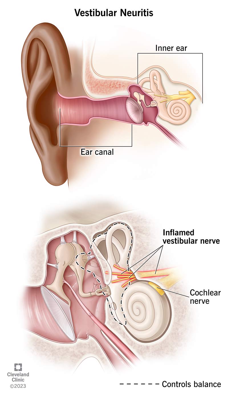 Cross section of inner ear highlighting an inflamed vestibular nerve.