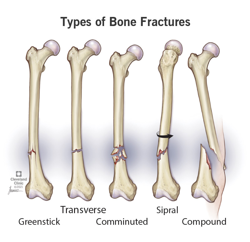 Illustrated comparison of different types of bone fractures