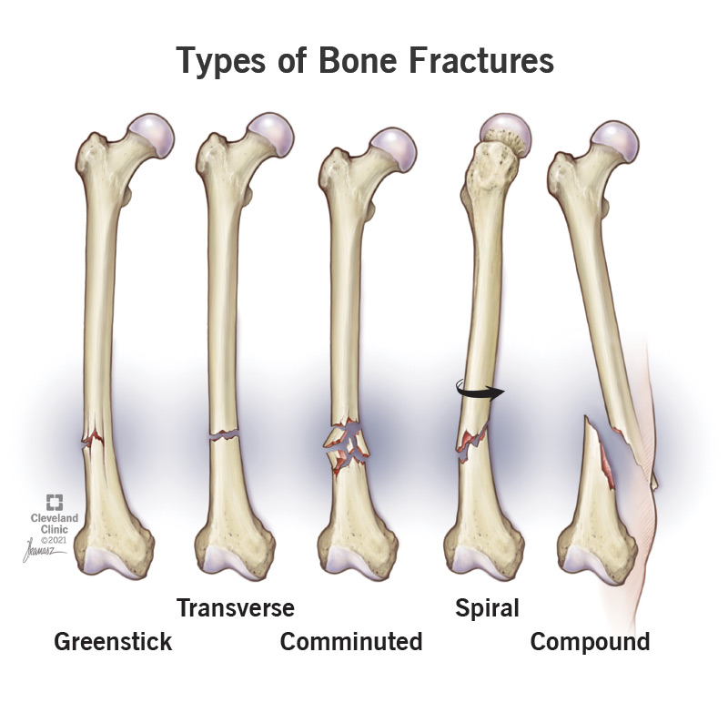 Illustrated comparison of different types of bone fractures