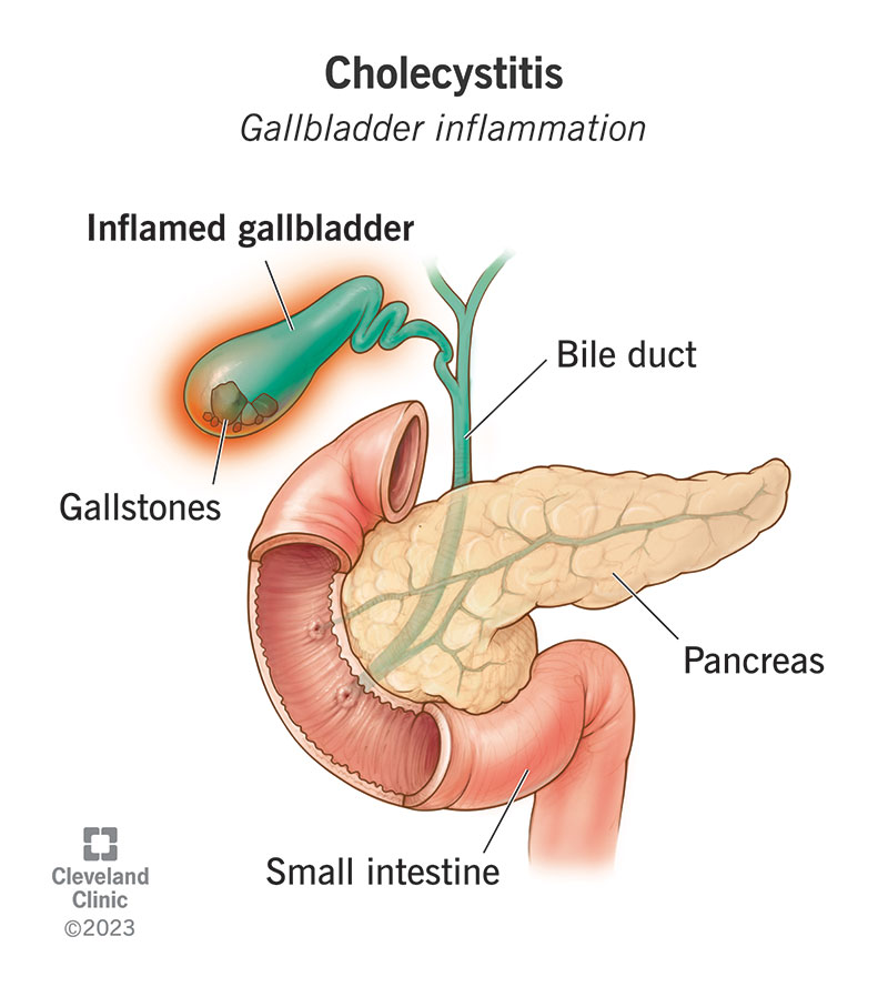 Signs deals of gallstones