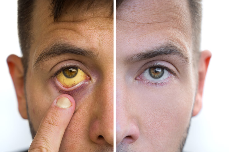 Same adult man with and without jaundice. Shows yellowed eye and skin from jaundice