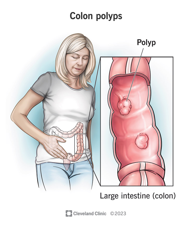 Colon polyps grow out of the inner lining of your colon. They can look like knobs or bumps.