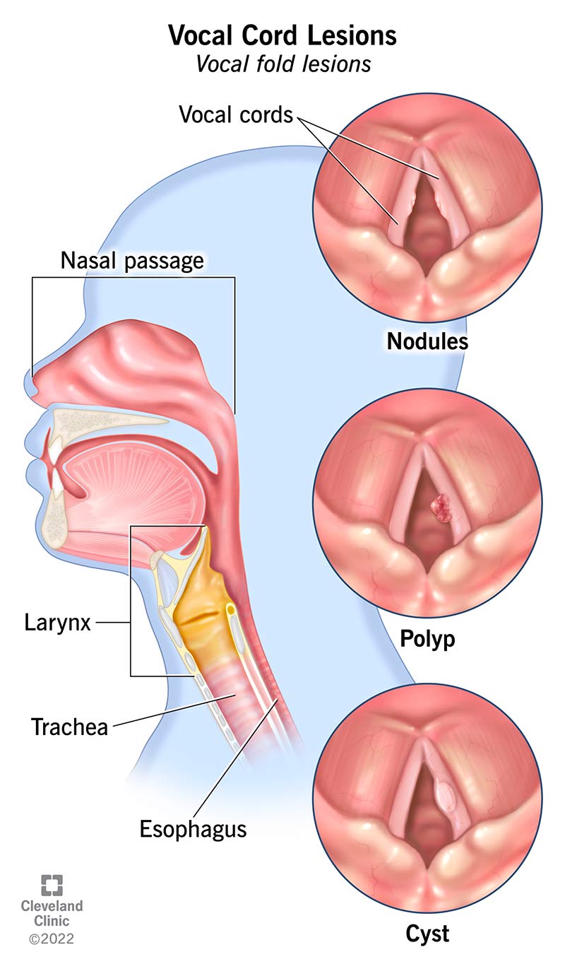 Comparison of a vocal cord nodule, polyp and cyst on opened vocal cords