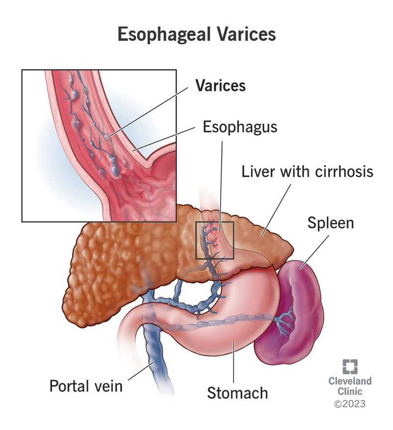 Liver with cirrhosis, enlarged portal vein and swollen esophageal varices.