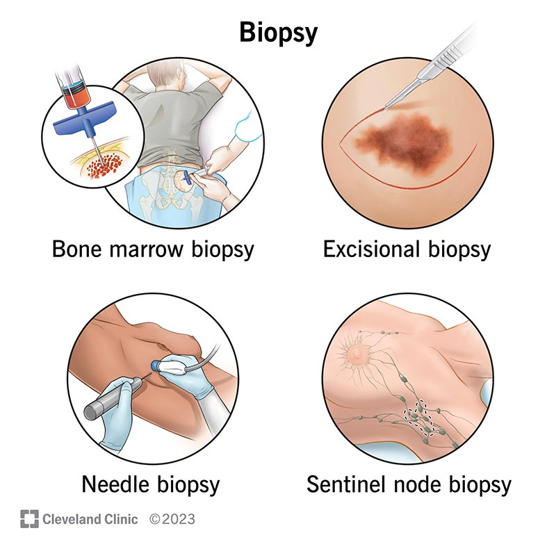 A biopsy removes samples of your tissue, cells or fluids so a medical pathologist can examine them for signs of disease.